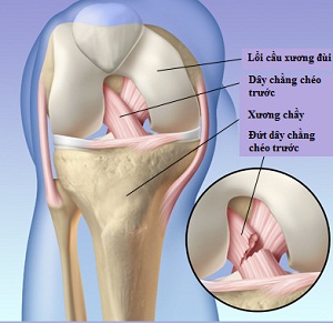 Chấn thương dây chằng chéo trước (Khớp gối) - Hình ảnh minh họa